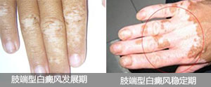 肢端型白癜风2.jpg