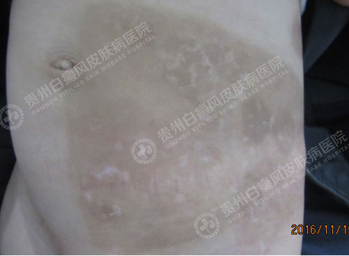 罗强治疗后.jpg